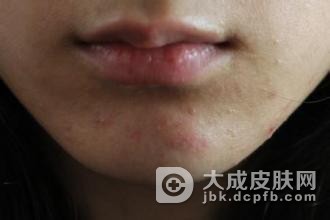 白头粉刺怎样日常治疗呢