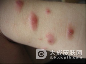 单纯痒疹的症状表现是什么