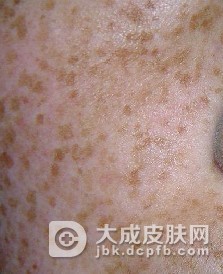 单纯性痒疹如何护理