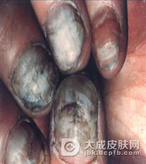 甲癣的症状类型有什么？