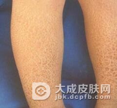 层板状鱼鳞病症状是什么呢