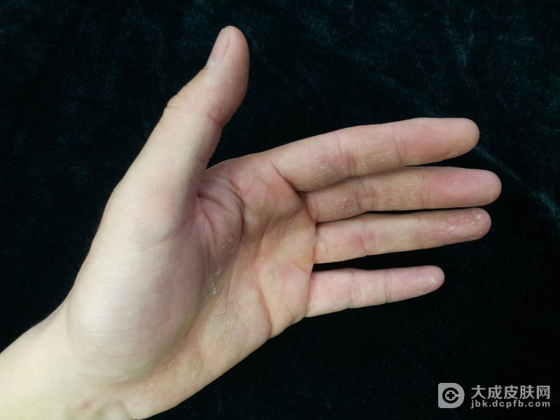 汗疱疹和手足皲裂如何区分？