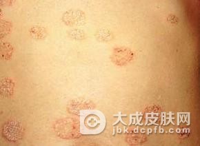 体癣的症状好治吗