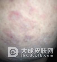 体癣的主要发病原因是什么