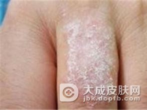 体癣日常生活应该注意什么