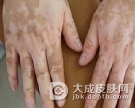 儿童白癜风怎么治疗