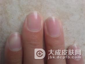 灰指甲怎么传染