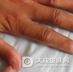 局限性硬皮病患者的护理措施有哪些