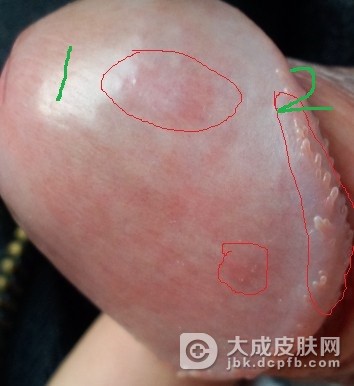 如何有效的预防性病的发生呢
