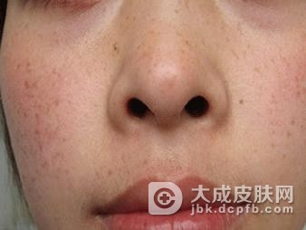 雀斑的预防措施怎么做好