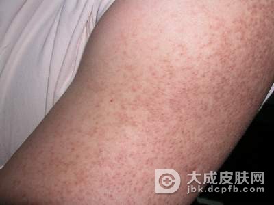 专家教你如何应对异位性皮炎