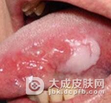 黏膜白斑的鉴别疾病