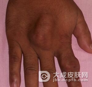 痛风病人的饮食