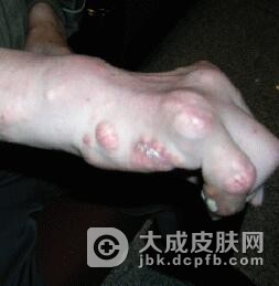 痛风的确诊标准是什么