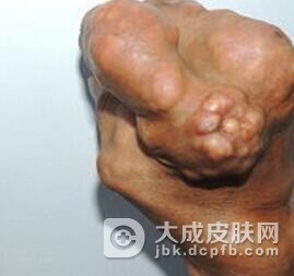 急性痛风的预防