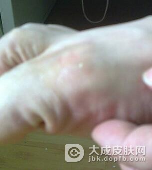 痛风会引起哪些并发症呢