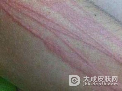 结节性痒疹有哪些症状体征