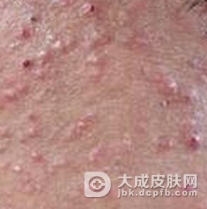 糠秕孢子菌毛囊炎是如何出现的