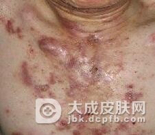 糠秕孢子菌毛囊炎的病理是什么