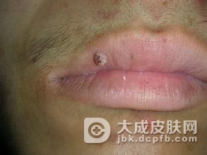 寻常疣有哪些预防要点呢