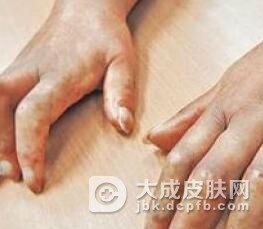硬皮病患者能否生孩子呢