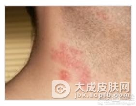 患有带状疱疹会表现出哪些危害