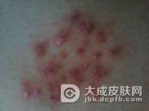 带状疱疹不治有什么损害呢