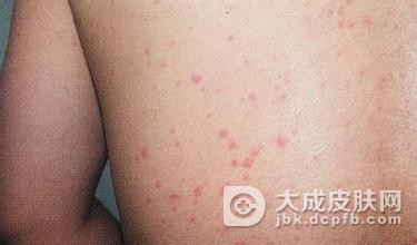 慢性荨麻疹患者皮肤护理措施