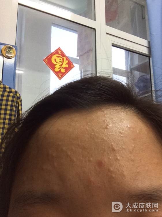 传染性软疣具有哪些危害