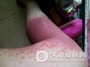 常见的红斑狼疮的预防方法