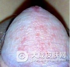 淋病的是通过什么方式传播的