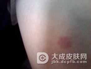 得了梅毒要注意哪些