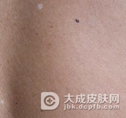 老年性白斑对于患者的影响分析