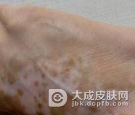 老年性白斑是否具有传染性分析