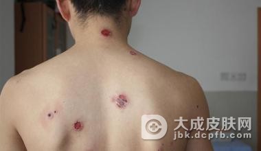 三期梅毒是怎样的呢