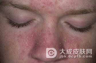 诊断脂溢性皮炎要注意哪些疾病