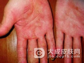 手部湿疹的发病症状表现有哪些