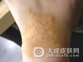 手部湿疹有哪些明显症状