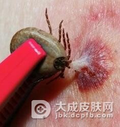 简述莱姆病的发生情况