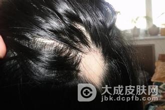 斑秃患者不适宜吃什么