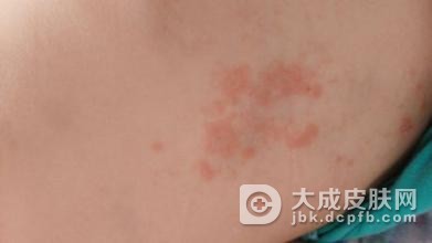 什么是色素性荨麻疹症候群