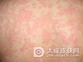 怎么预防荨麻疹的发生