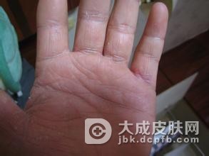 手足癣患者在夏天治疗需要注意什么呢