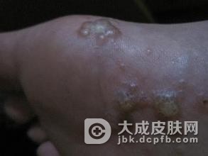 手足癣会有哪些并发症