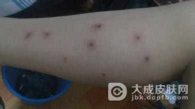 丘疹性荨麻疹的发作特点是什么