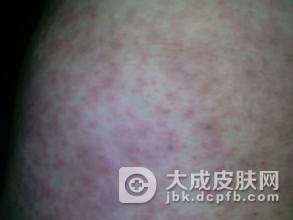 如何通过吃来调节和缓解丘疹性荨麻疹