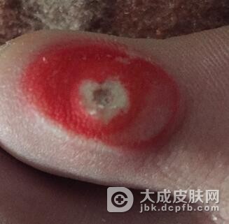 鸡眼日常如何护理