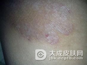 远离冬季皮肤瘙痒的方式