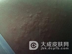 冬季应对皮肤瘙痒的方法有哪些