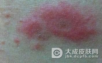 皮肤瘙痒症的人群应该在冬季如何去保养呢